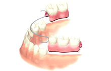 部分入れ歯